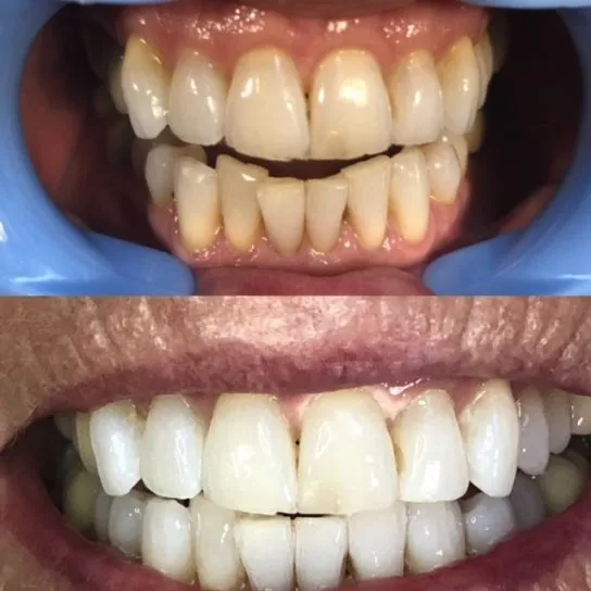 32823 long island teeth whitening options