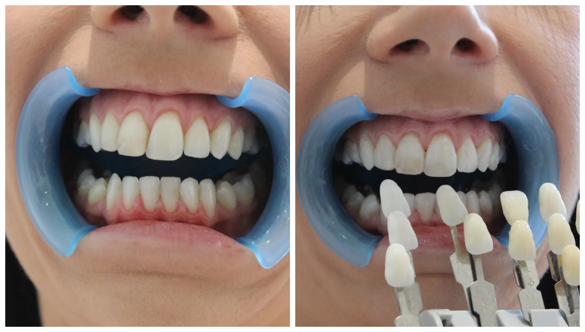 32827 teeth whitening before after
