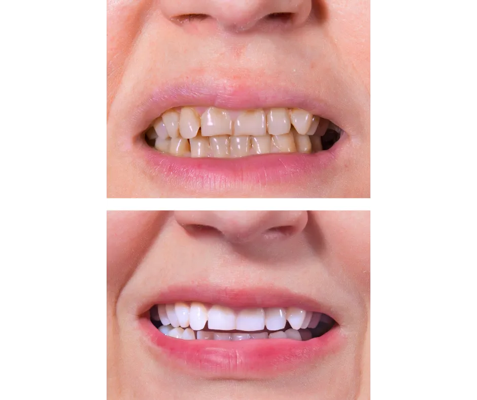 32836 teeth whitening turlock ca image2
