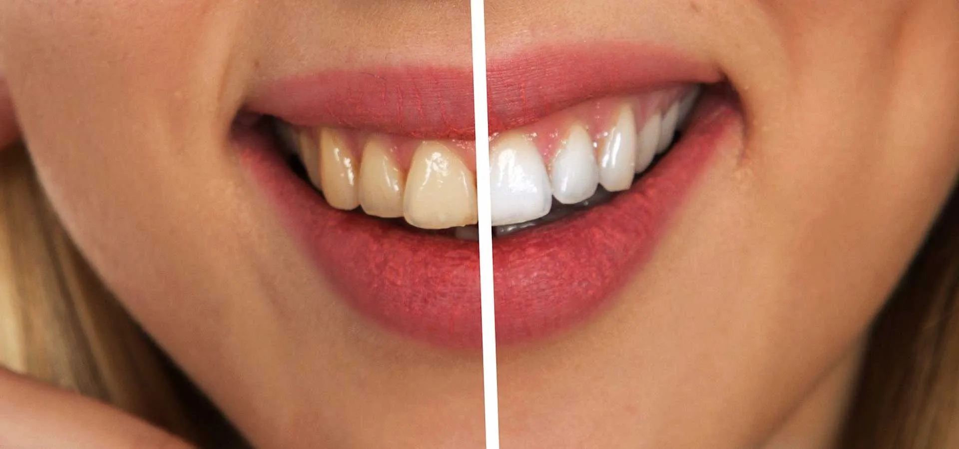 32844 tooth whitening sensitivity