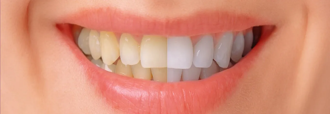 32845 at home teeth whitening kits