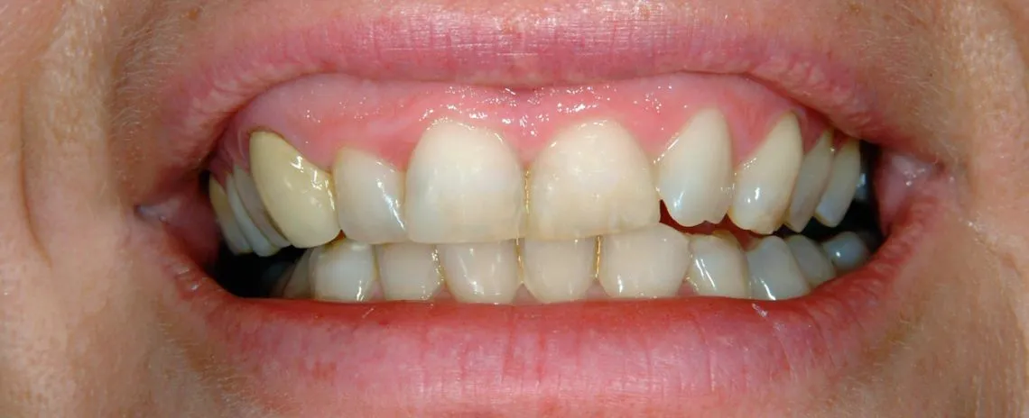 32845 teeth whitening cost considerations