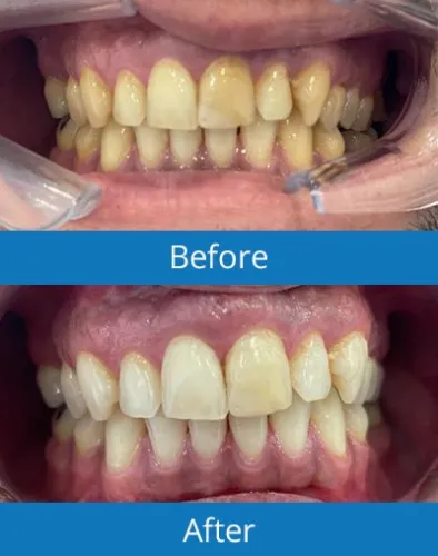 32845 teeth whitening laser