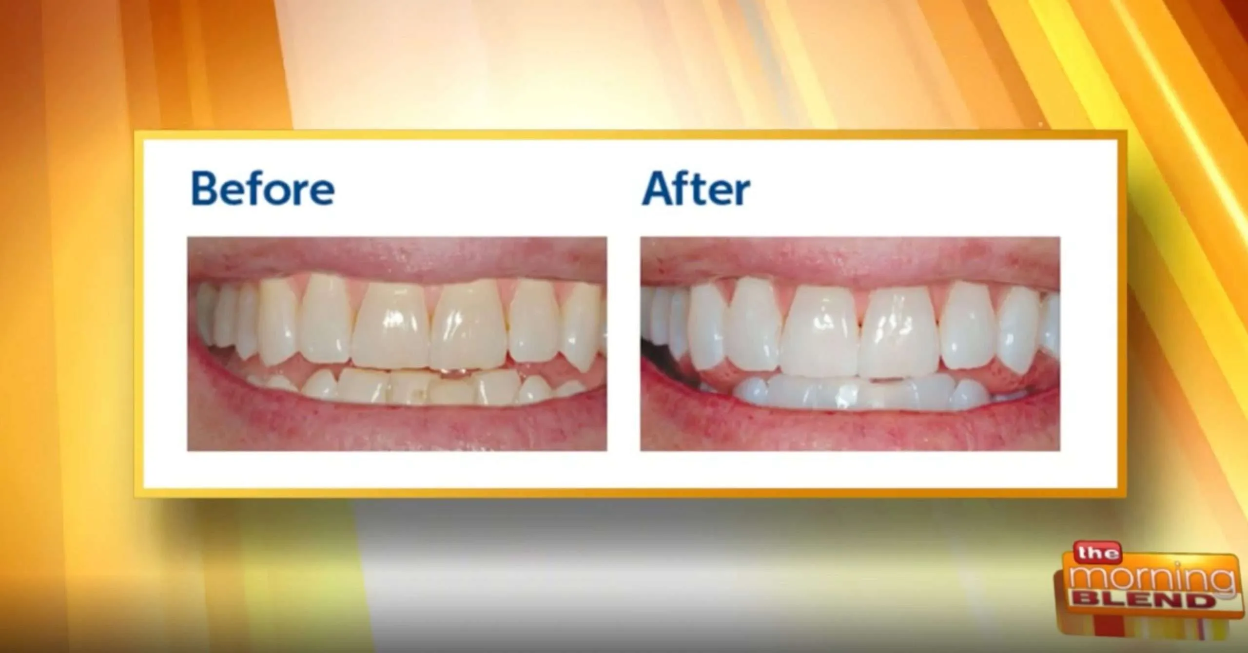 32849 in office whitening