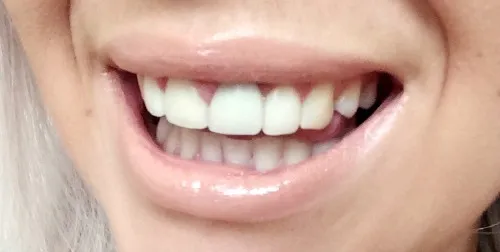 32853 blanx kit pros cons