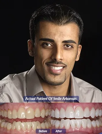 32858 in office teeth whitening