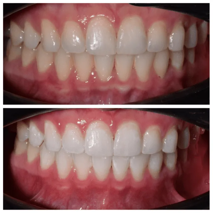 32882 cleaning whitening trays
