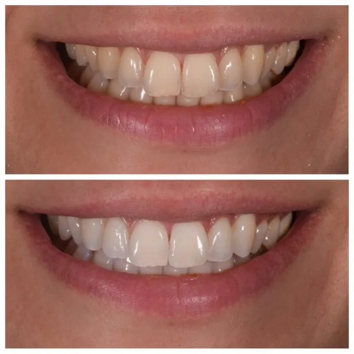 32882 teeth whitening results