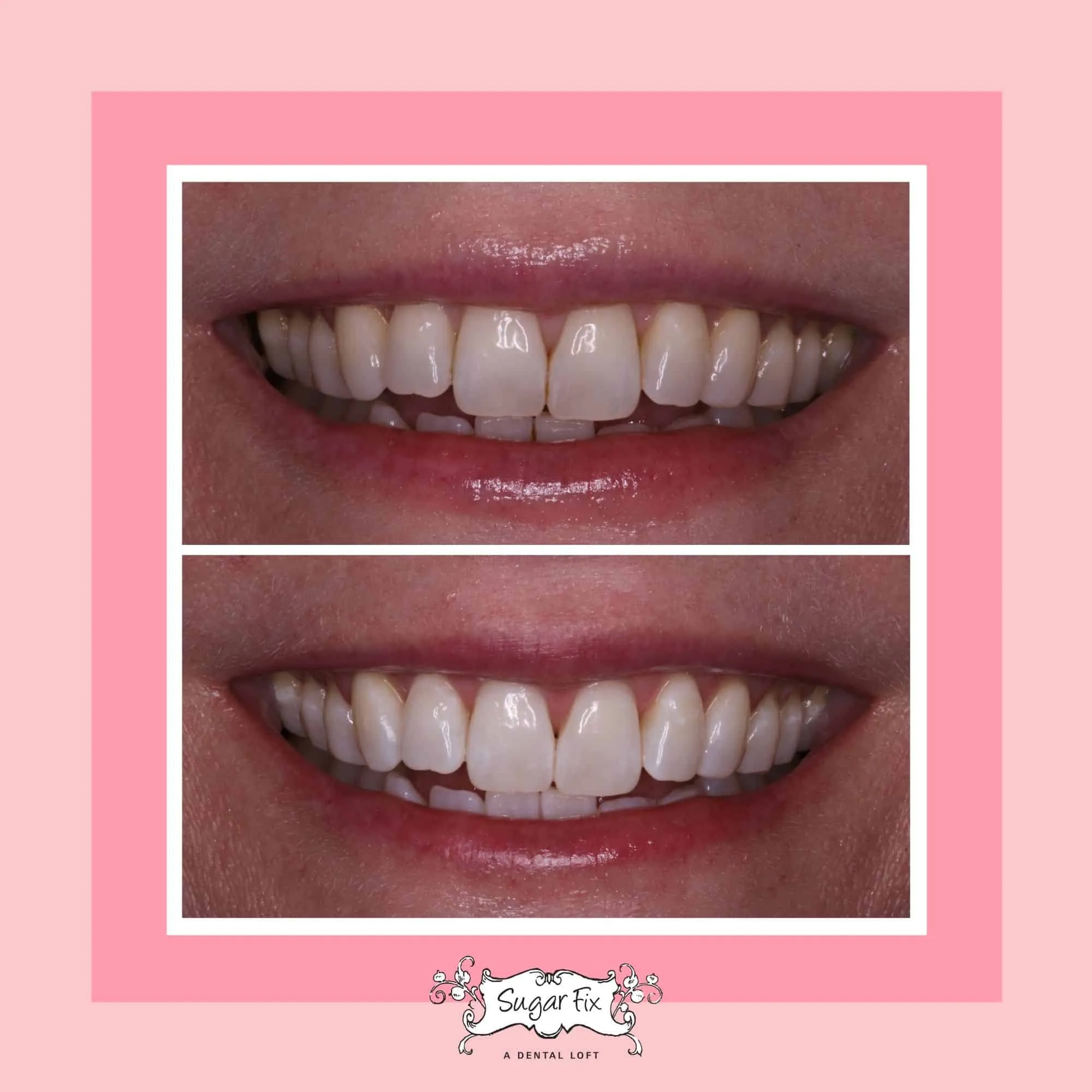 32883 applying whitening gel