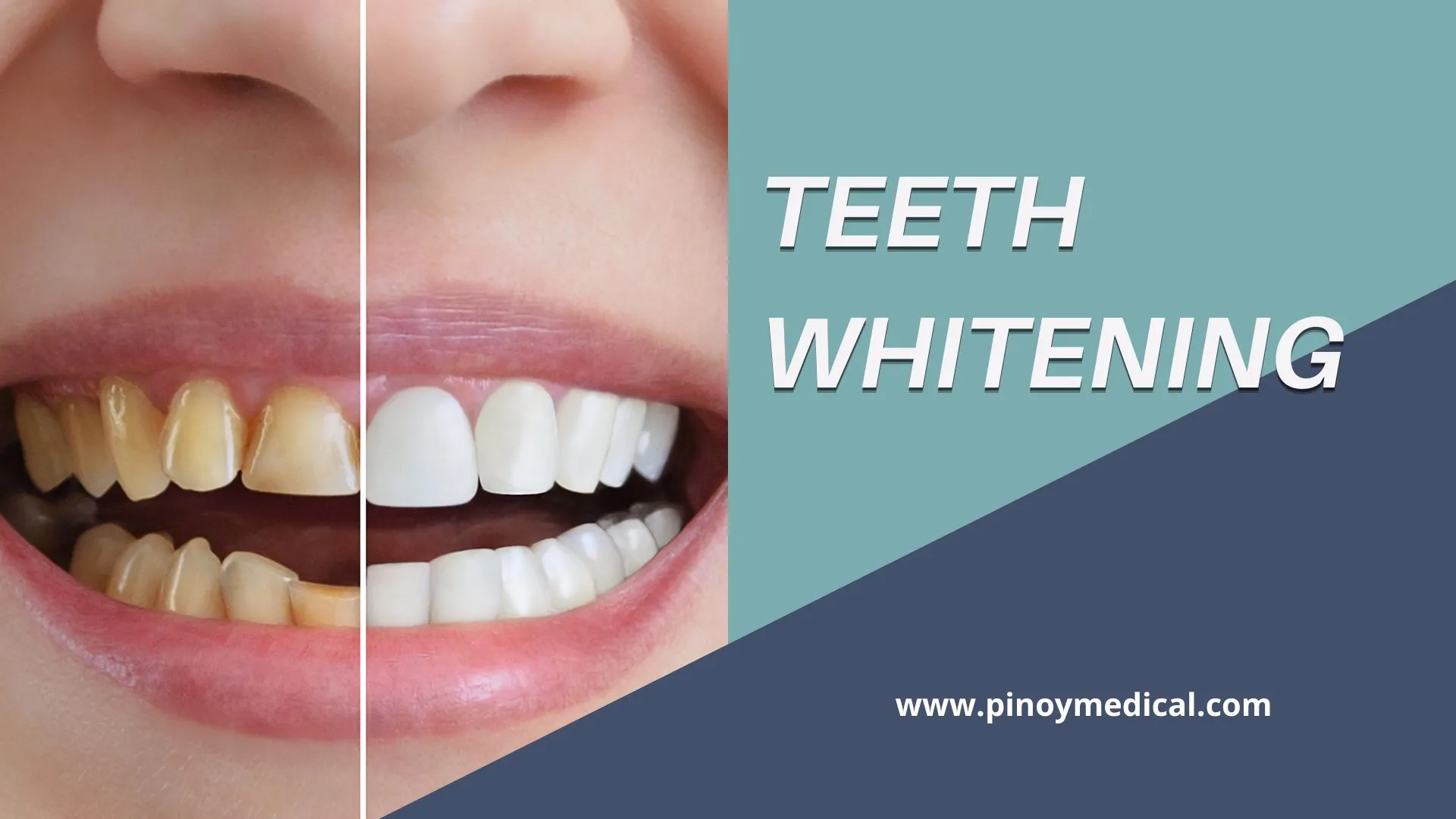 32885 teeth whitening uganda 5
