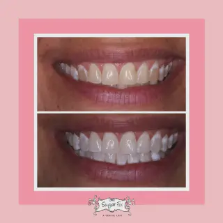 /img/32891-teeth-whitening-aftercare.webp