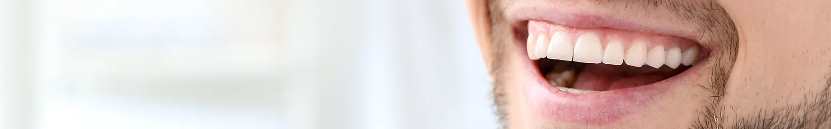 32891 teeth whitening lincoln before after