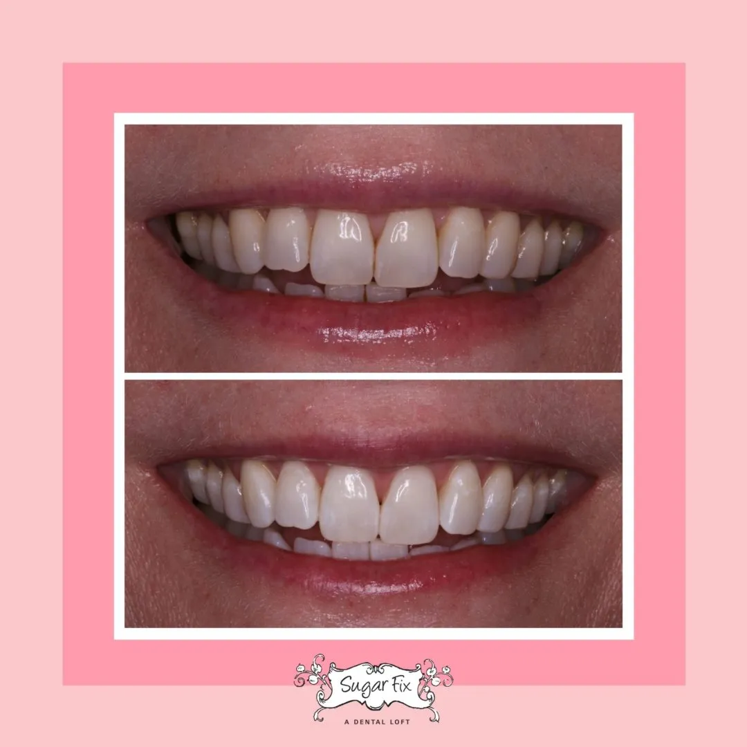 32891 teeth whitening procedure