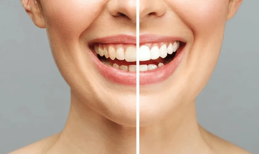 32907 davinci teeth whitening