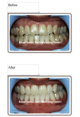 /img/32907-teeth-whitening-results.webp