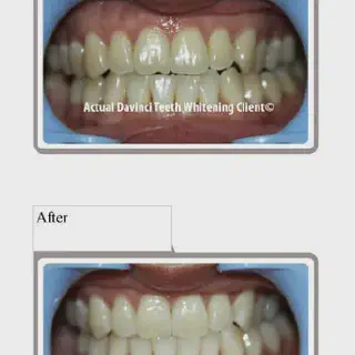 /img/32907-teeth-whitening-results.webp