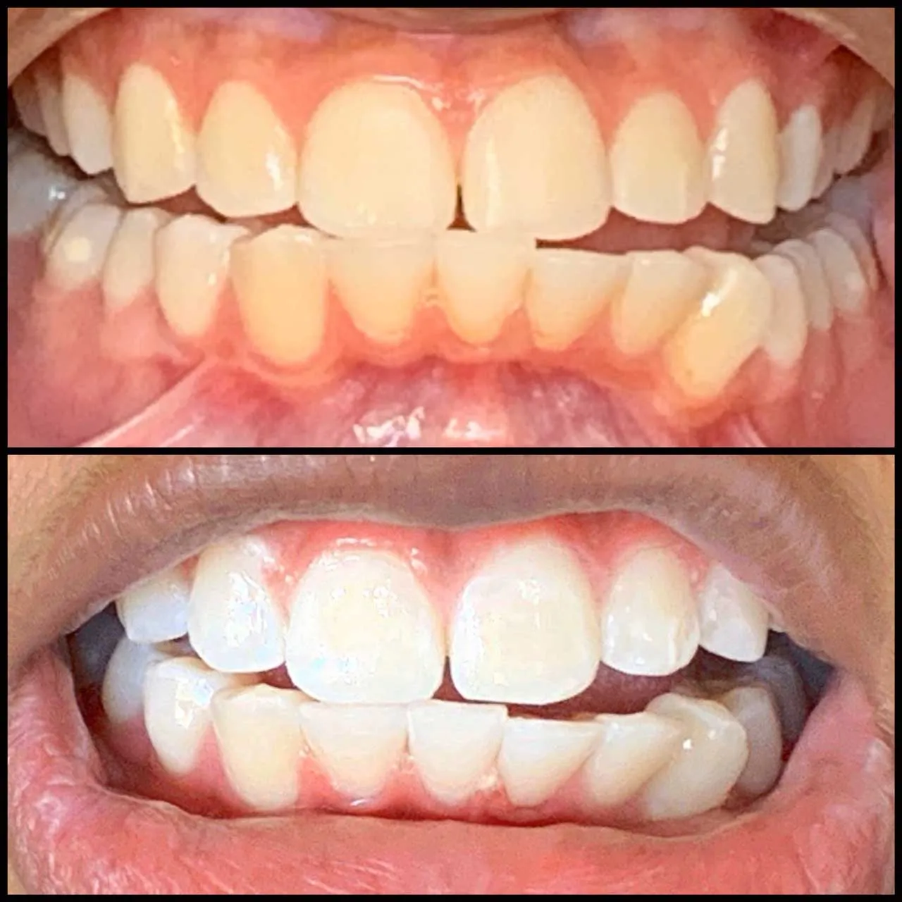 /img/32918-teeth-whitening-results.webp