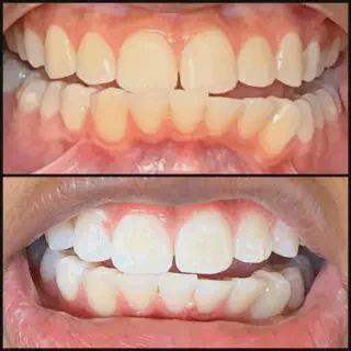 /img/32918-teeth-whitening-results.webp