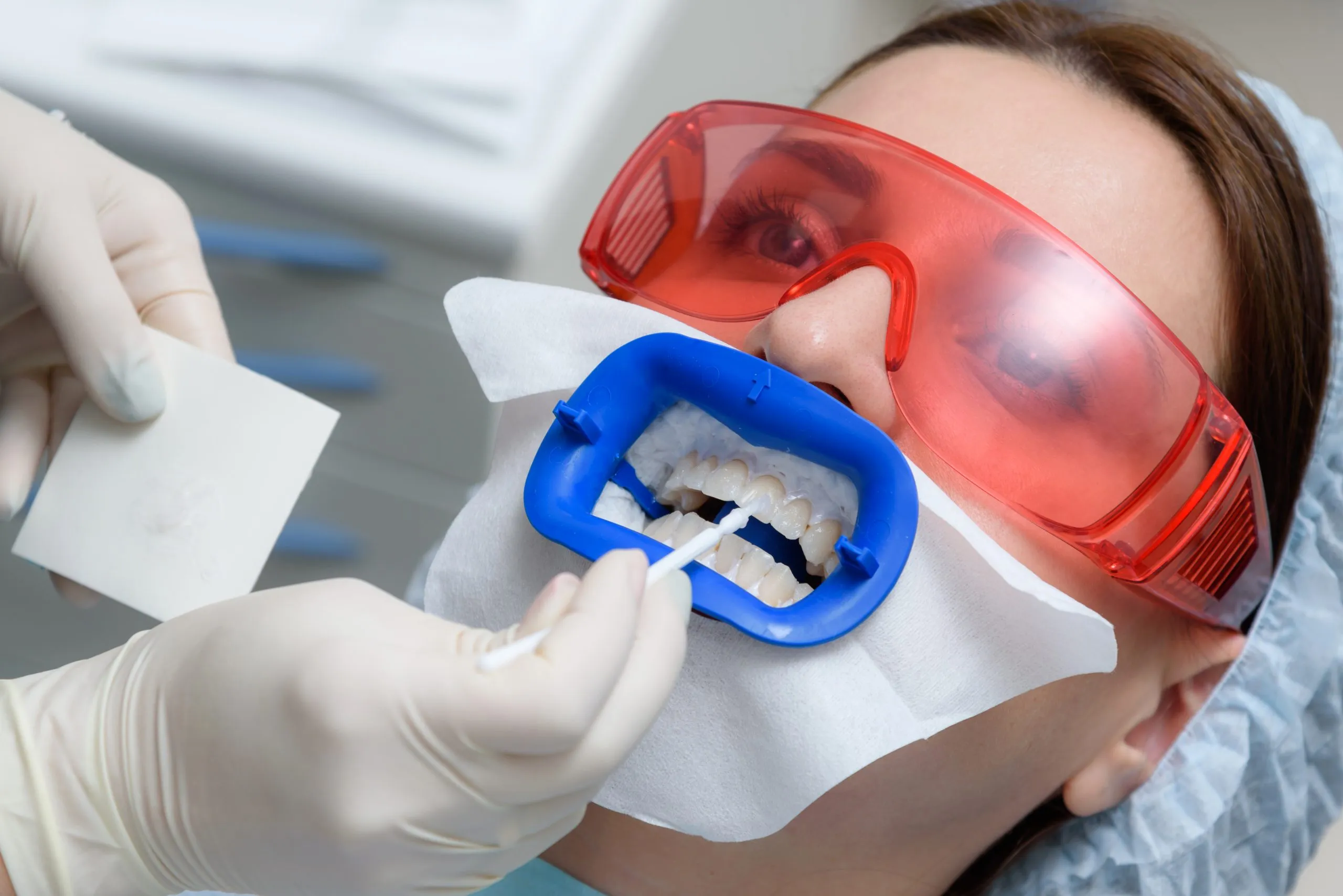 32919 tooth whitening seattle image1