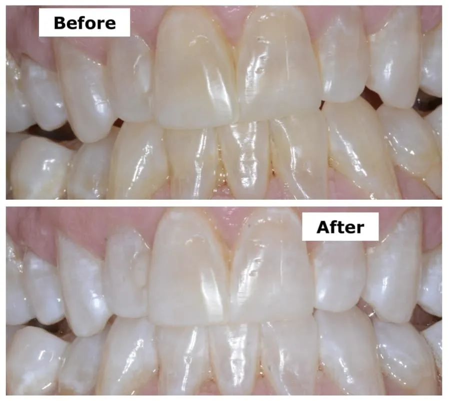 32919 tooth whitening seattle image3