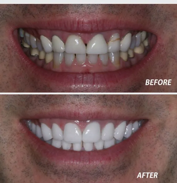 /img/32923-teeth-whitening-strips.webp