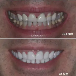 /img/32923-teeth-whitening-strips.webp