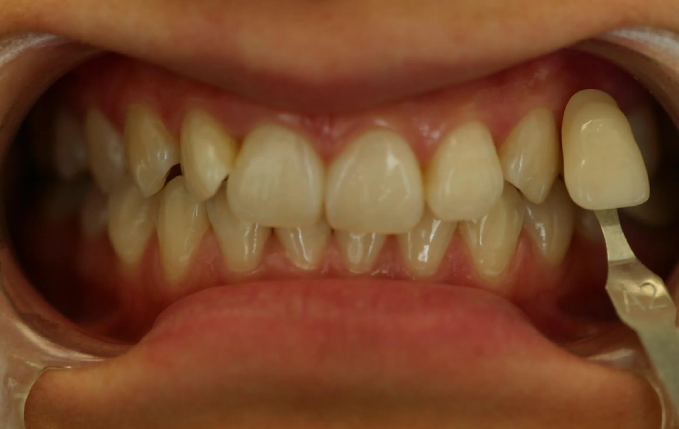 32928 zoom whitening aftercare 1