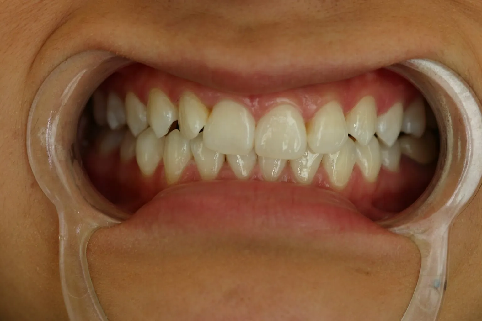 32928 zoom whitening aftercare 2