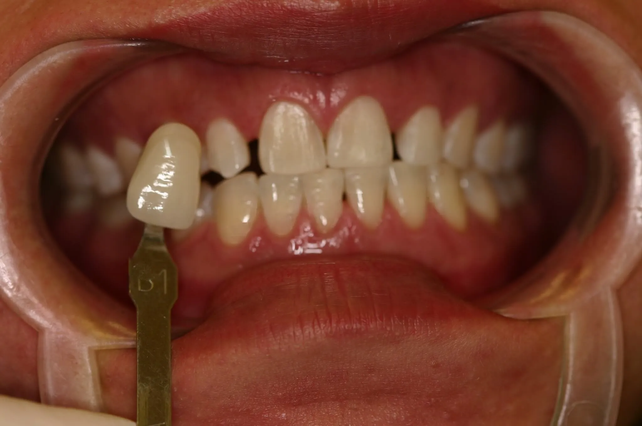 32928 zoom whitening aftercare 4