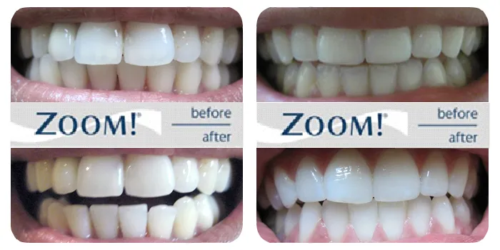 /img/32928-zoom-whitening-aftercare-7.webp