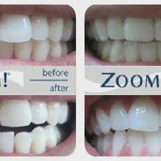 /img/32928-zoom-whitening-aftercare-7.webp