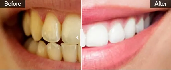 32932 whitening trays