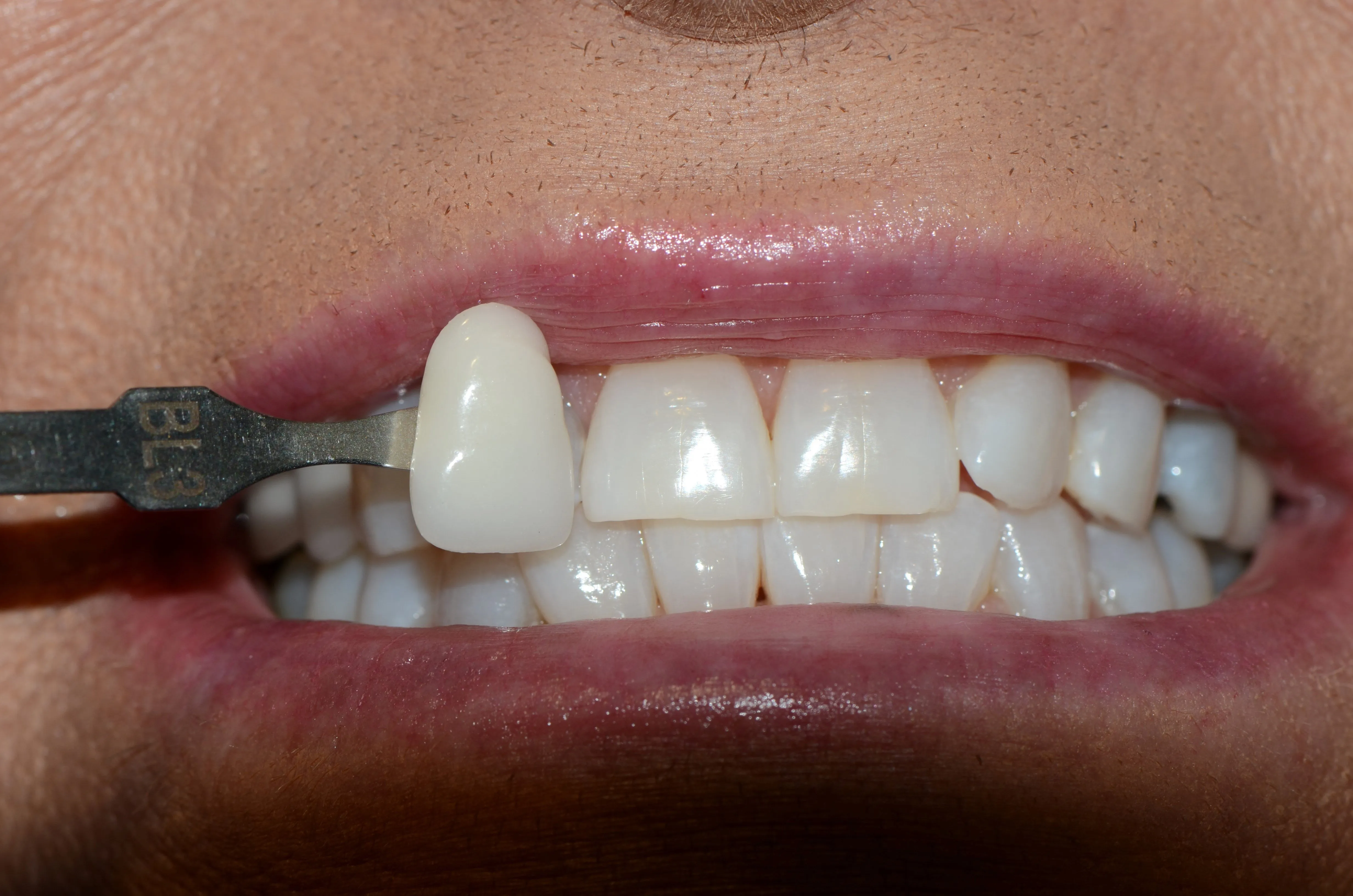 32938 baking soda teeth whitening