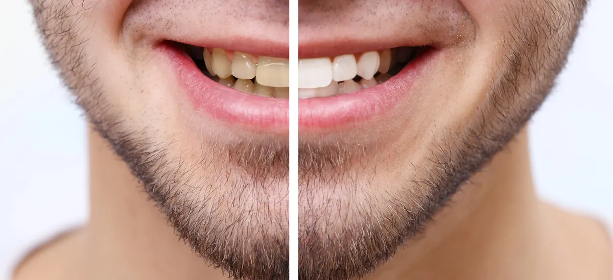 32942 kor whitening system overview