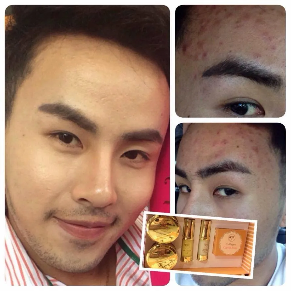 32947 thailand whitening treatment