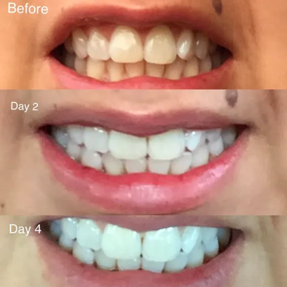 32950 whitening teeth application