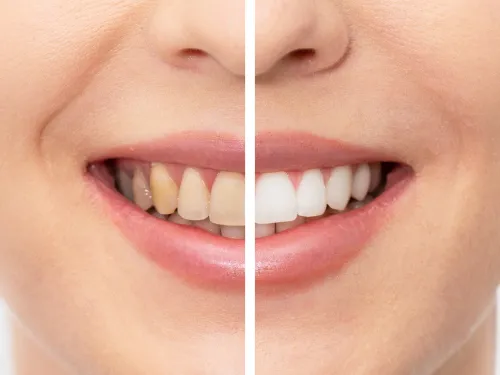 32957 teeth whitening college station image2