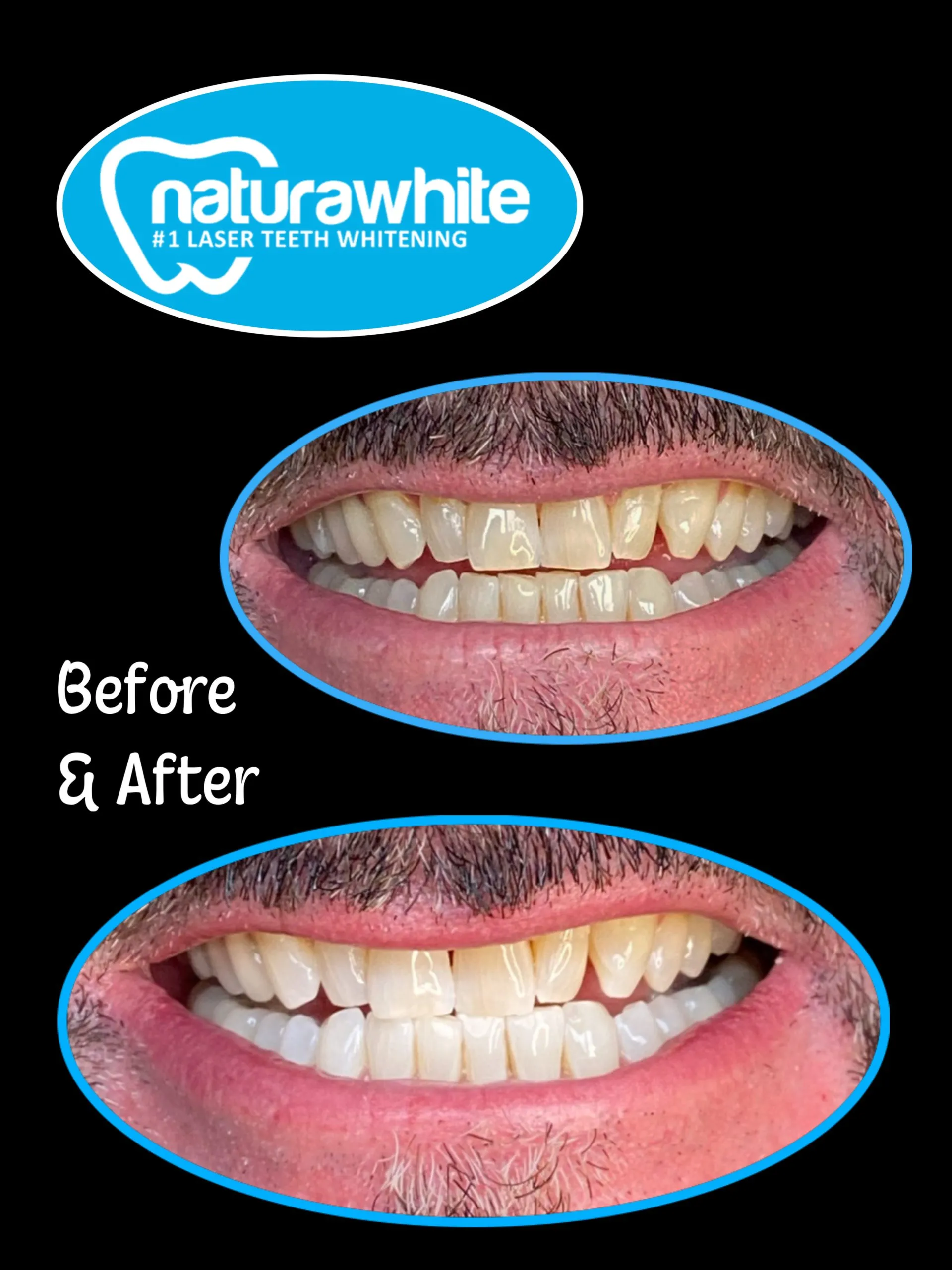32960 laser teeth whitening confidence
