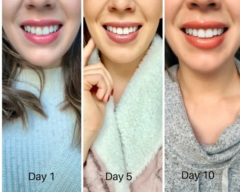 32962 teeth whitening products comparison