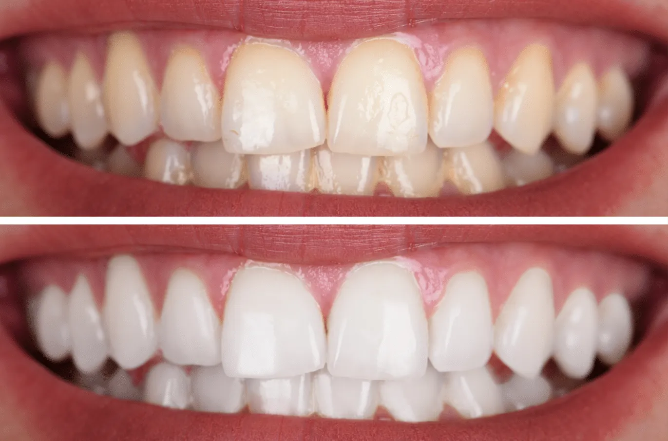 32967 comfort dental teeth whitening overview