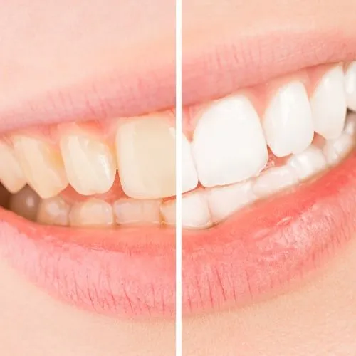 32978 teeth whitening options