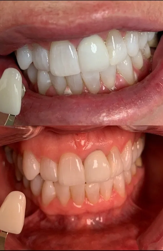 32981 safe foods after whitening