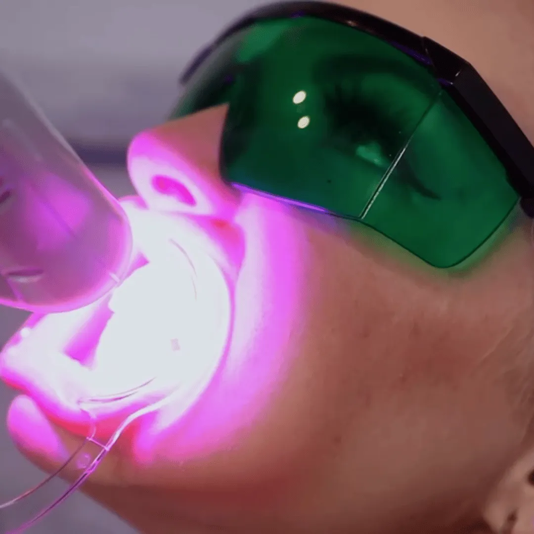 32987 laser teeth whitening amazon kit 2