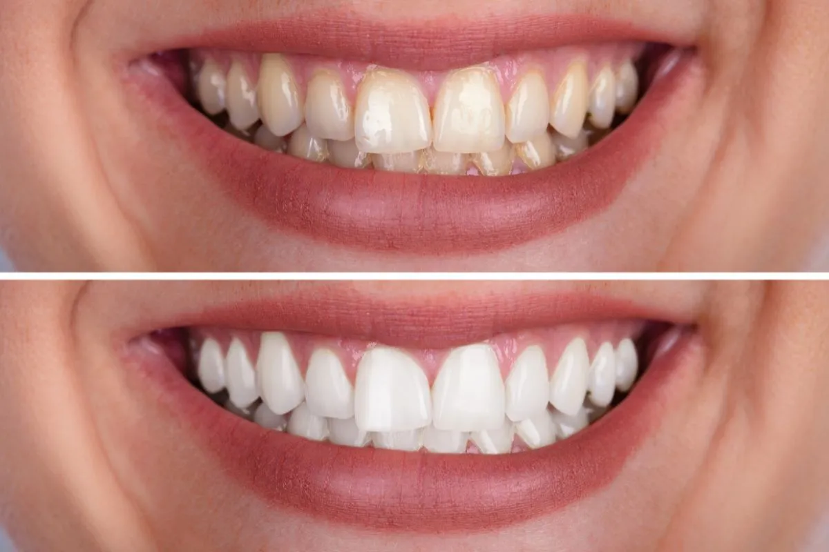 32988 tooth whitening bad for enamel 4