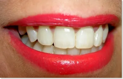 32988 tooth whitening bad for enamel 6
