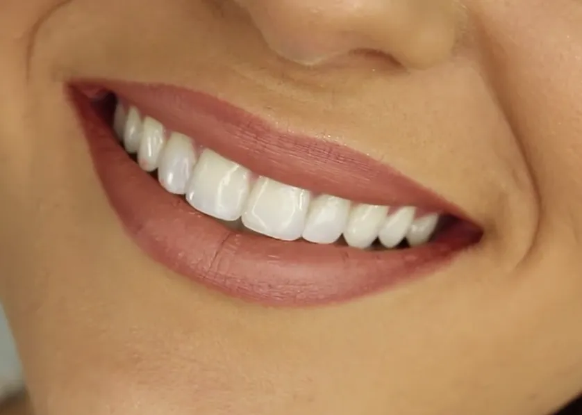 /img/32988-tooth-whitening-bad-for-enamel-7.webp