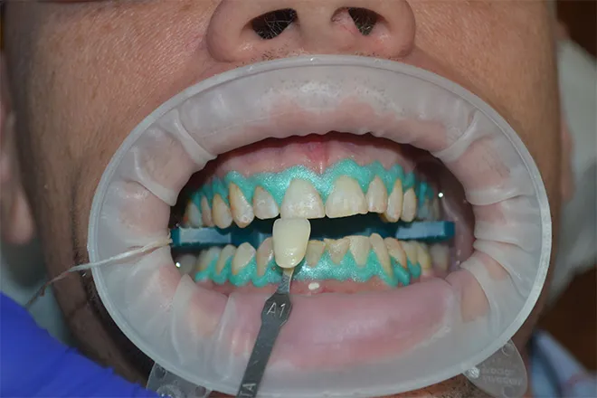 32989 professional teeth whitening kits