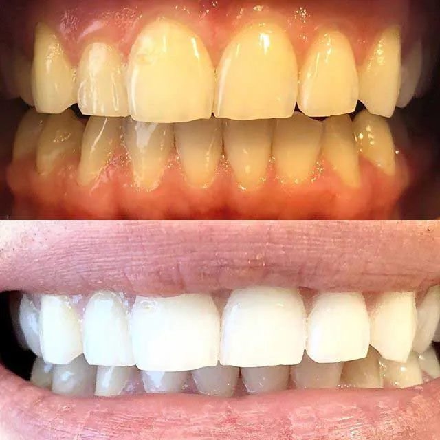 32989 teeth whitening food stains